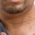 Acrochordon: What Are They?