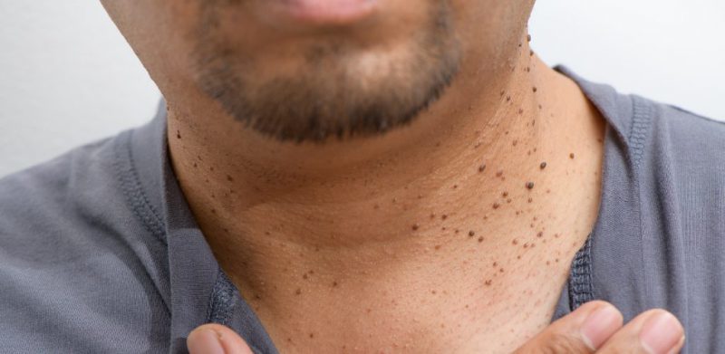 Different Types of Treatments for Skin Tag Removal - IPLOverview